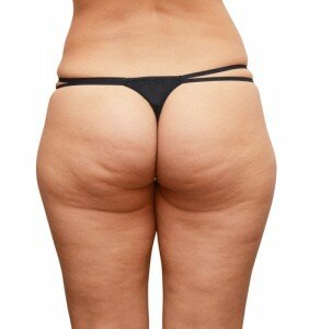 cellulite issues