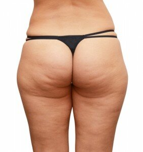 tips for cellulite cellulite issues